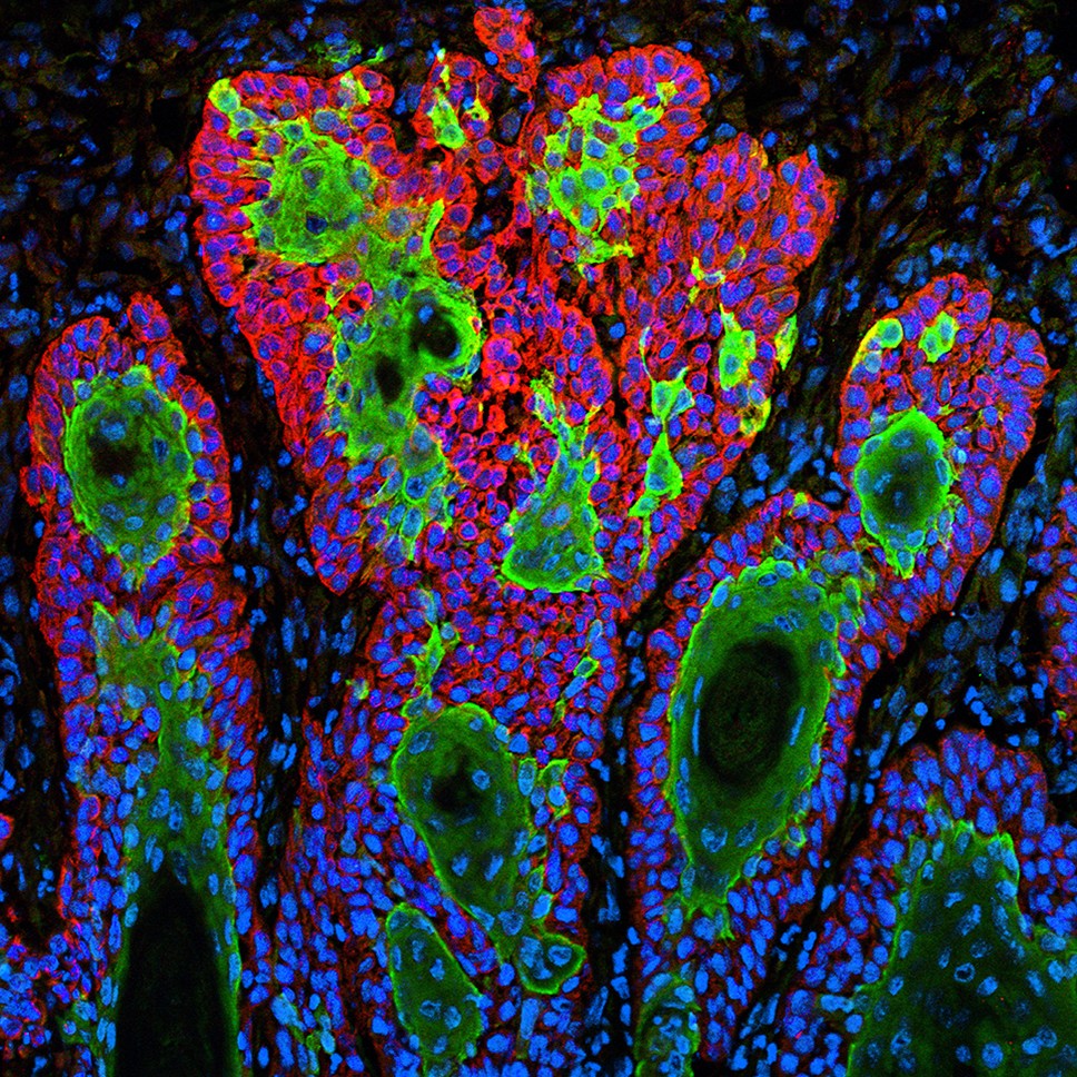 1618550734715519.jpg schober-fuchs-carcinoma.jpg